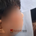 വളയത്ത് വീട്ടുമുറ്റത്ത് കളിച്ചുകൊണ്ടിരുന്ന അഞ്ചുവയസുകാരനെ കടിച്ചു കുടഞ്ഞ് തെരുവുനായ ; ഗുരുതര പരിക്ക്