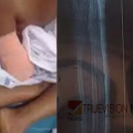 സ്റ്റിച്ചിട്ട ഭാഗത്ത് പഴുപ്പ്; ചികിത്സാ പിഴവിനെ തുടർന്ന് കൈ മുറിച്ചുമാറ്റിയ ഒമ്പതു വയസുകാരിക്ക് കോഴിക്കോട് മെഡിക്കൽ കോളജിൽ വീണ്ടും സർജറി