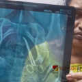 അഞ്ചുവർഷം വയറ്റിൽ കത്രികയുമായി വീട്ടമ്മ; വണ്ടാനം മെഡിക്കല് കോളജ് ആശുപത്രിയിലെ ശസ്ത്രക്രിയയ്ക്കിടെ കുടുങ്ങിയതെന്ന് ആരോപണം