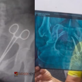 കത്രിക വയറ്റിൽക്കിടന്ന് ദ്രവിച്ചു, മൂത്രസഞ്ചിക്ക് മുറിവ്; ആലപ്പുഴയിലെ ചികിത്സാപ്പിഴവിൽ പോലീസ് അന്വേഷണം ഊർജിതം
