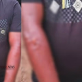 കടുത്ത ചൂട്: കൂത്താട്ടുകുളത്ത് ഇതരസംസ്ഥാന തൊഴിലാളിക്ക് സൂര്യാതപമേറ്റു