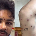 കോക്രോച്ച് ജനതാ പാർട്ടി പാർലമെന്റ് മാർച്ച്; പെല്ലറ്റ് ആക്രമണത്തിൽ പരിക്കേറ്റ വിദ്യാർഥിയുടെ കാഴ്ച നഷ്ടപ്പെട്ടേക്കുമെന്ന് ആശങ്ക
