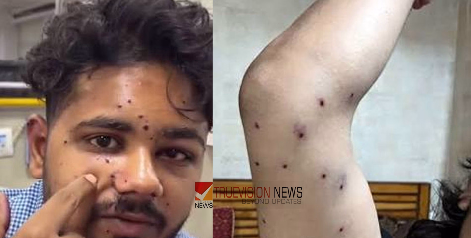 കോക്രോച്ച് ജനതാ പാർട്ടി പാർലമെന്റ് മാർച്ച്; പെല്ലറ്റ് ആക്രമണത്തിൽ പരിക്കേറ്റ വിദ്യാർഥിയുടെ കാഴ്ച നഷ്ടപ്പെട്ടേക്കുമെന്ന് ആശങ്ക