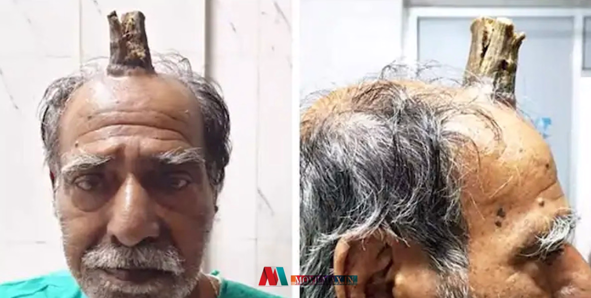 #viral | 'ചെകുത്താന്‍റെ കൊമ്പു'മായി ജീവിച്ച ശ്യാം ലാല്‍ യാദവ്; ഒടുവില്‍ സംഭവിച്ചത്