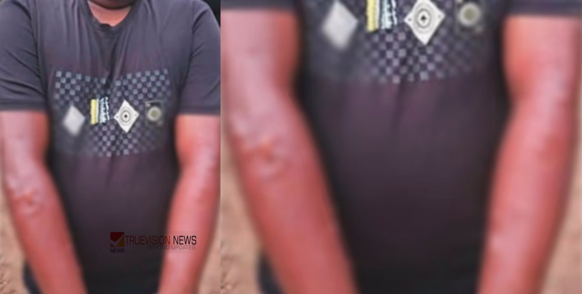 കടുത്ത ചൂട്: കൂത്താട്ടുകുളത്ത് ഇതരസംസ്ഥാന തൊഴിലാളിക്ക് സൂര്യാതപമേറ്റു